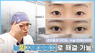 쌍꺼풀 겹주름, 처진눈들 수술이 아니라 눈위지방재배치로 간단하게 가능? | 눈위지방재배치잘하는병원   | AND(앤드)성형외과 | 눈서코TV