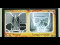 CT scan sinuses (Hindi) Patient teaching programme