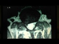 Spine Lecture: Intervertebral Discs of the Spine