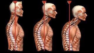 How to TRULY correct forward head posture