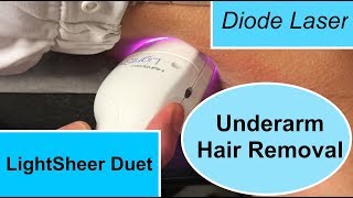 The LightSheer Duet Diode Laser for Underarm Hair Removal