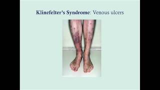 Klinefelter's Syndrome - CRASH! Medical Review Series