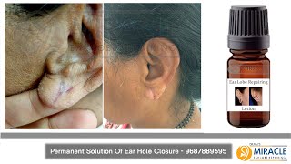 Ear Pasting Lotion / Glue Torn Ear lobe repaired  Earlobe / Hole Repair / - Call -  9687889595