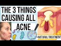 What Causes Pimples? THE 3 THINGS THAT CAUSE PIMPLES (+ Curing Acne NATURALLY)