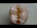 2023 adex dental exam 30 seconds molar class ii review