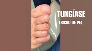 RETIRADA DE TUNGÍASE (BICHO DE PÉ) #podologia #ingrowntoenail