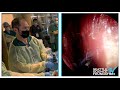 surgical demo pituitary approach u0026 nasoseptal flap greg e davis m.d.