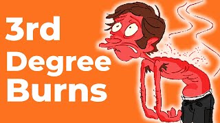 3rd Degree Burns: Everything You Should Know | Wound Care OC