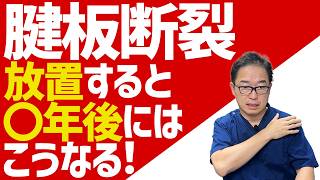 【腱板断裂】肩のズキズキ痛み…腱板断裂を放っておくと、こうなります。