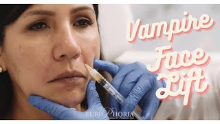 Vampire Face Lift: Non Surgical Face Lift at EuroPhoria