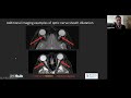 learn how imaging is crucial to diagnosing idiopathic intracranial hypertension iih