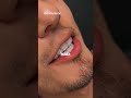 Carillas dentales #dientes #dentista #tips #parati #viral #fyp #shorts #shortvideo #fypシ