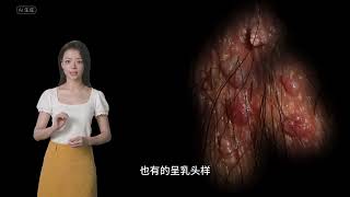 男性肛周尖锐湿疣早期症状图片-南京优嘉病毒疣医学研究所