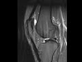 chondral fissure causing anterior knee pain