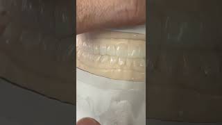 For 28 teeth Diagnostic wax up!