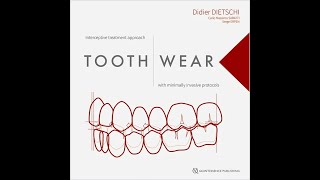 tooth wear review