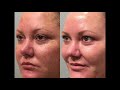 ipl for pigmentation treatment video