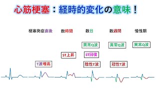 心電図：暗記からの卒業 55話 心筋梗塞の心電図変化