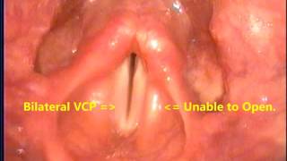 雙側聲帶麻痺 甲狀腺手術後 Bilateral VCP after thyroidectomy.