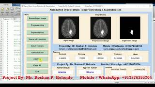 Matlab Code for Type of Brain Tumor Detection Using Image Processing