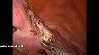 Fascial Anatomy and Its Relevance in Safe Laparoscopic Hysterectomy