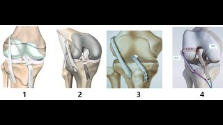 Over-The-Top Technique for Revision ACL Reconstruction| OTT technique