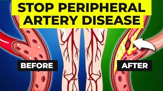 The Surprising Cause of Peripheral Artery Disease