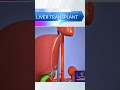 Liver Transplant #liver #shorts