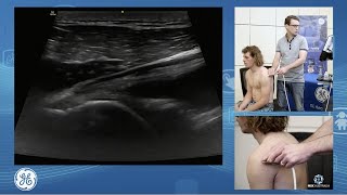 Sonographic assessment of the glenohumeral joint for POCUS Clinicians