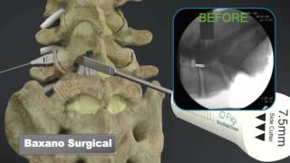 Sciatica Surgery, Dr. John Small - Florida Orthopaedic Institute