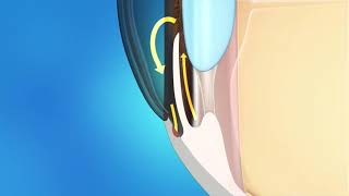 Glaucoma Animation