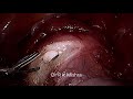 learn steps of total laparoscopic hysterectomy in 15 minutes with dr r k mishra