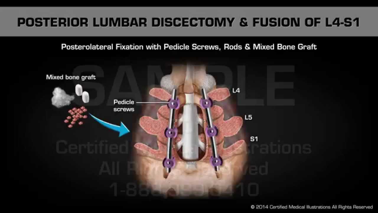 Lumbar Laminectomy With Fusion