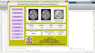 Brain Tumor Types Detection and Classification using Matlab Project Code