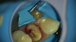 Tratament de canal la microscop/retratament premolar / dr. Dan Țugulea