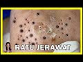 ACNE ASMR Diet Sehat untuk Mencegah Jerawat