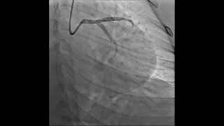 Coronary angiogram showing stent deployed.