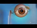 What is endoscopic dacryocystorhinostomy (DCR) surgery for blocked tear ducts?