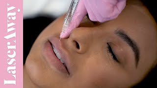 Lips By LaserAway | Juvederm | Ask Dr. Kirby