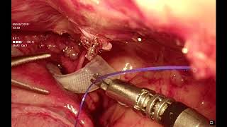 Laparoscopic placement of a hydraulic occluder