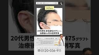 【斎藤医師の症例ファイル027_自毛植毛1475グラフト】後退したM字部分に確実に髪の毛を生やす！ #shorts