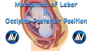 Mechanism of Labor in Occipito-Posterior Position