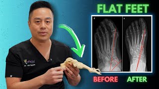 👣 FLAT FEET FAM. Facts You Need to Know! 😳🦶