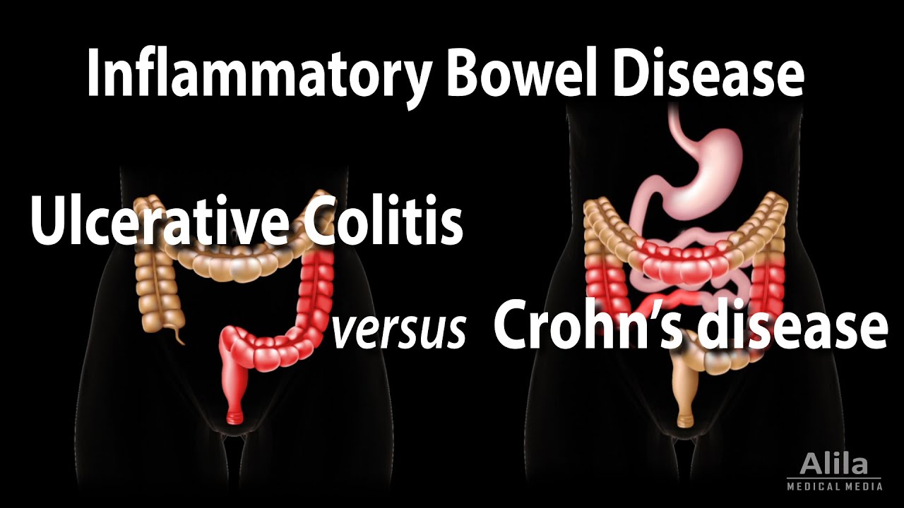 Ulcerative Colitis Versus Crohn's Disease, Animation - YouTube