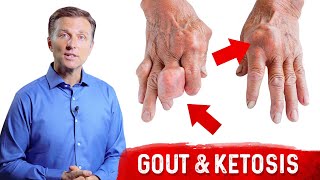 Gout \u0026 Ketosis – Uric Acid Stones \u0026 High Uric Acid On Keto – Dr. Berg