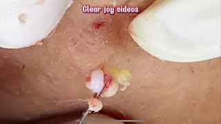 Big Cystic Acne Blackheads Extraction Blackheads \u0026 Milia, Whiteheads Removal Pimple Popping