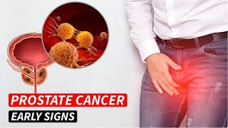 WARNING! 4 EARLY SIGNS OF PROSTATE CANCER MOST PEOPLE MISS! - DON’T IGNORE!