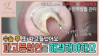 파고든 원인을 해결해야 또 파고들지 않아요 ingrown toenail / ingrowing nail - Fresh Foot 풋풋한리쌤 성수점 / 평내호평점