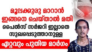 സർജറി ഒന്നും ഇല്ലാതെ തന്നെ മൂലക്കുരു മാറ്റിയെടുക്കാൻ ഇത് മാത്രം മതി