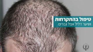 טיפול בהתקרחות ושיער דליל אצל גברים